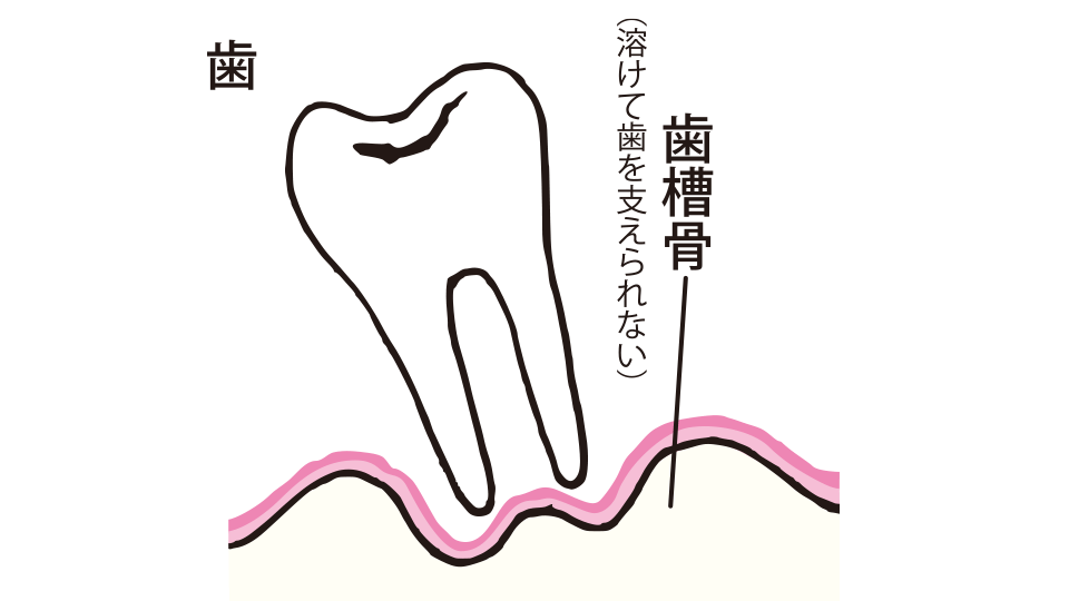 溶けた歯槽骨